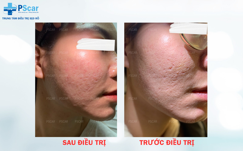 Bôi tế bào gốc sau laser Bôi tế bào gốc sau laser