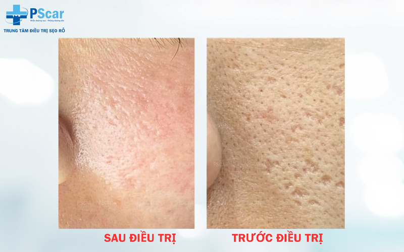 Bôi tế bào gốc sau laser