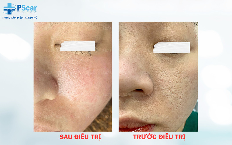 Bôi tế bào gốc sau laser Trong quá trình sử dụng tế bào gốc, bạn nên nhớ một số lưu ý để đảm bảo có hiệu quả tốt nhất