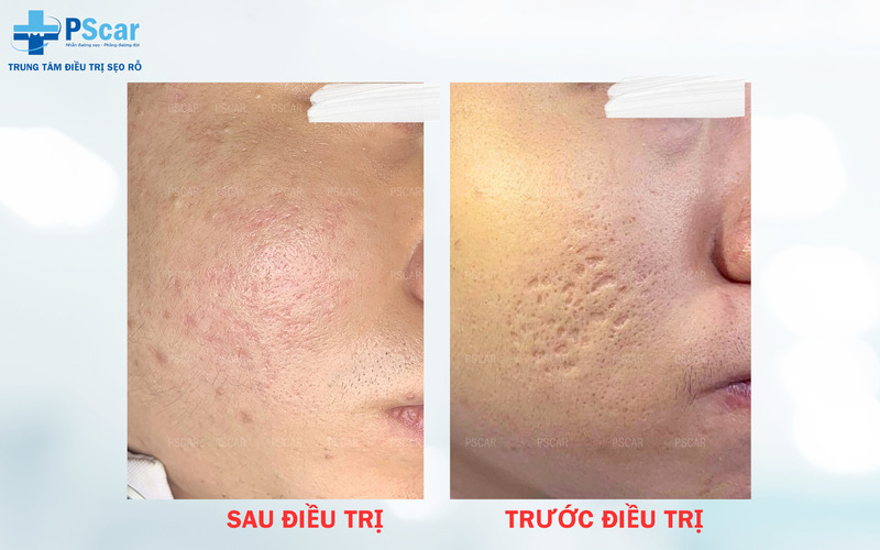 PSCARI được biết đến là một địa chỉ bắn sẹo rỗ uy tín hiện nay