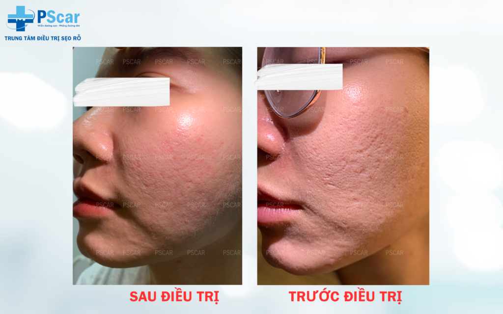 Laser CO2 Fractional là gì