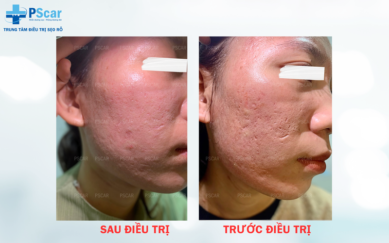 Sau lăn kim bao lâu da trở lại bình thường