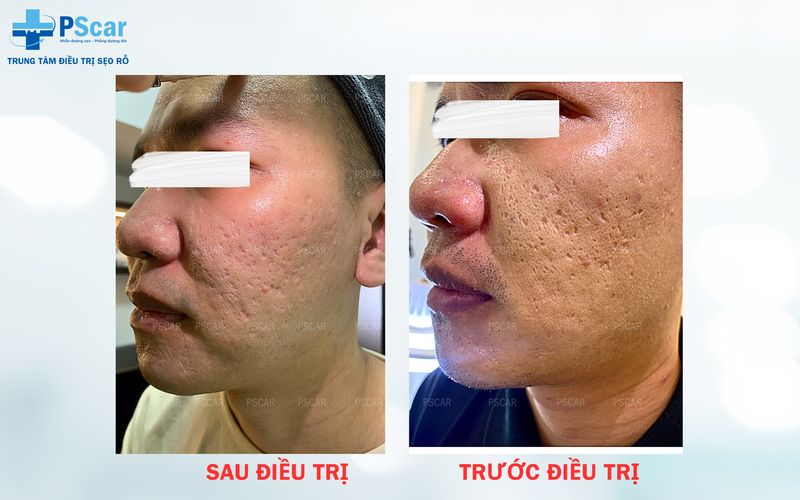 Tình trạng da sau laser