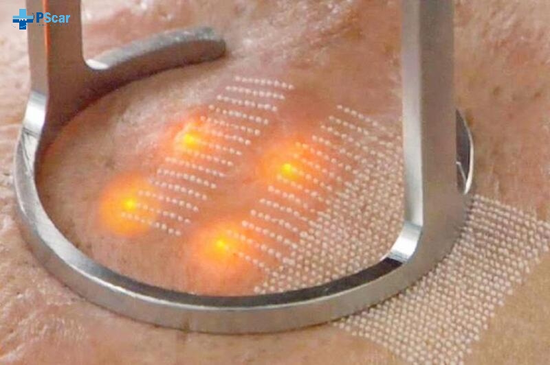 Liệu pháp laser là một giải pháp hiện đại trong việc điều trị sẹo rỗ