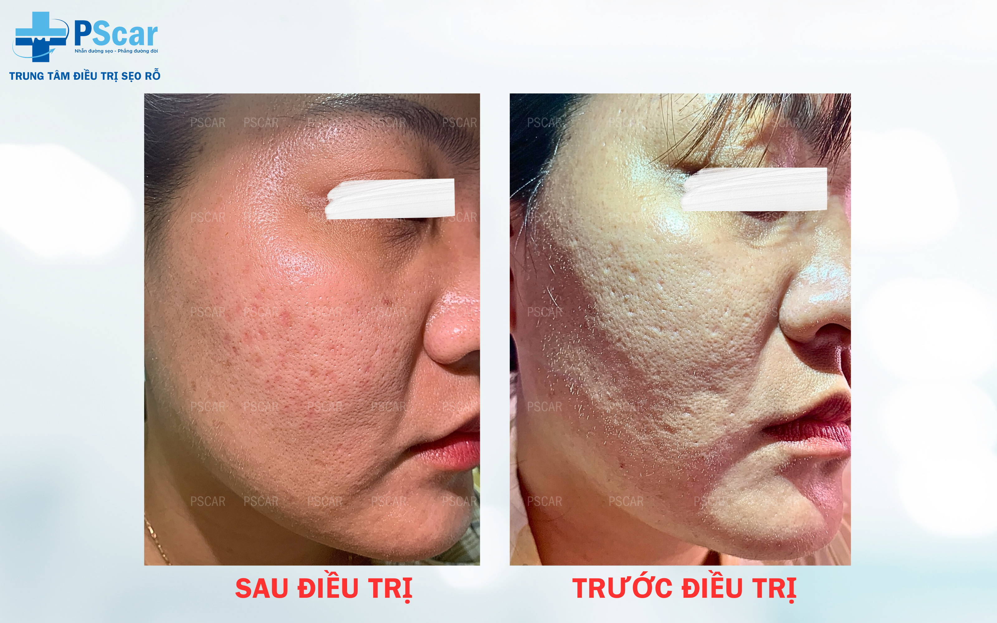 Xoá sẹo bằng laser