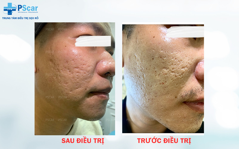 xóa sẹo lõm trên mặt lâu năm