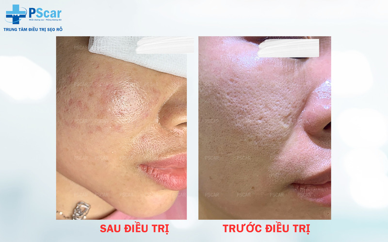 xóa sẹo lõm trên mặt lâu năm