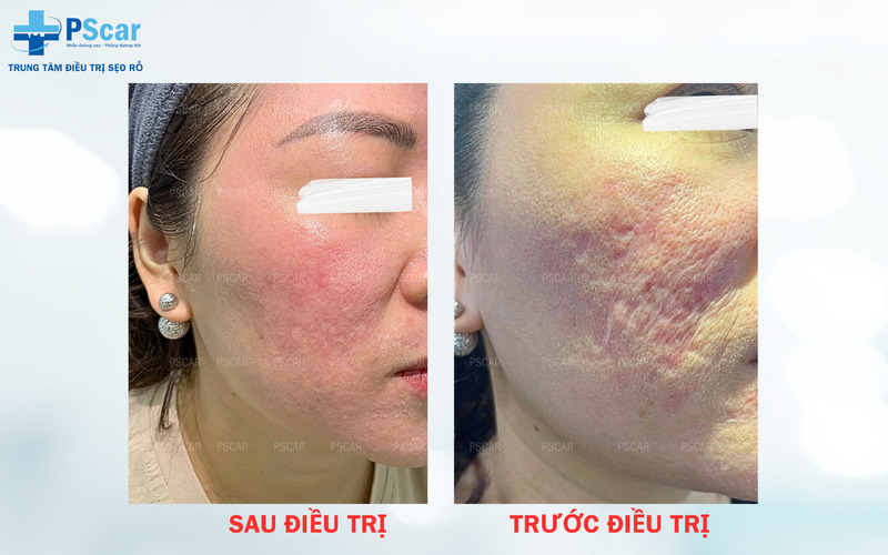 xóa sẹo lõm trên mặt lâu năm