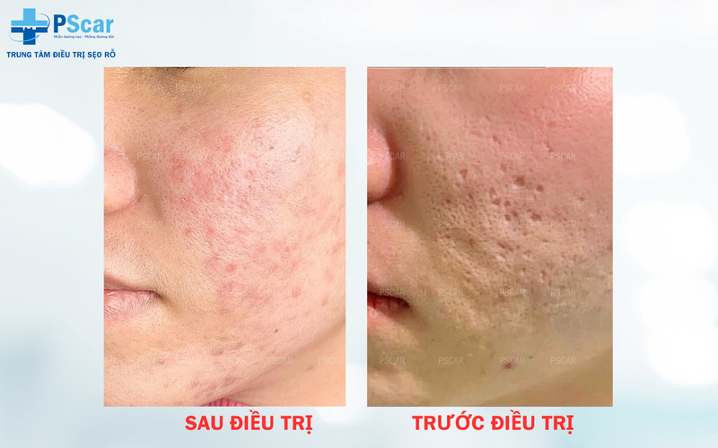 Bóc tách đáy sẹo thường được sử dụng để phá vỡ các mô sẹo dưới da