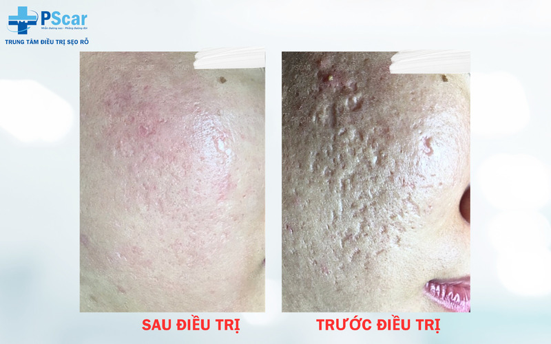 PSCAR - Một địa chỉ chuyên cung cấp dịch vụ xóa sẹo lõm lâu năm trên mặt uy tín nhất