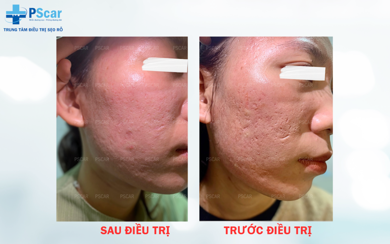 1 liệu trình lăn kim bao nhiêu tiền