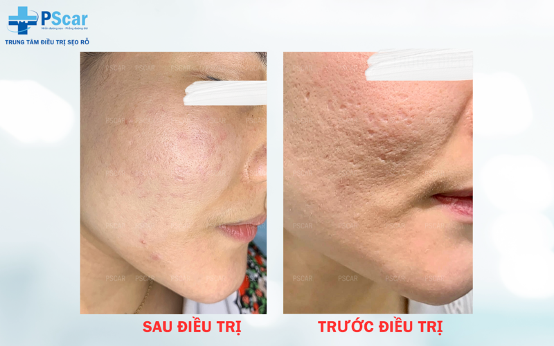 Kỹ năng và kinh nghiệm của bác sĩ là yếu tố quan trọng ảnh hưởng đến giá của liệu trình lăn kim