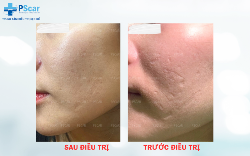 Chất lượng của cơ sở thẩm mỹ là yếu tố quyết định giá của liệu trình trị sẹo