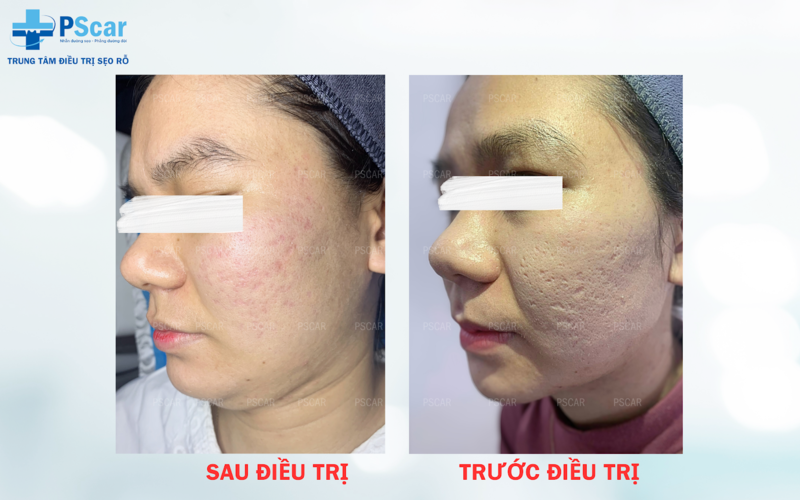 Các phương pháp điều trị sẹo hiện nay rất đa dạng