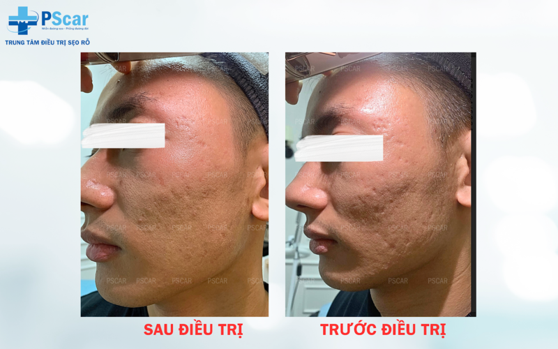 Chi phí điều trị sẹo rỗ không cố định mà phụ thuộc vào đặc điểm của từng sẹo