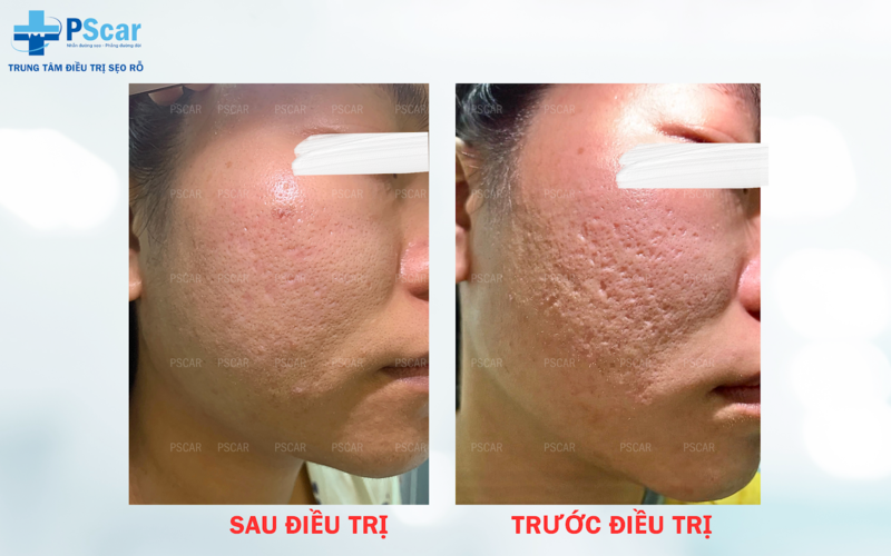 Chi phí cho một liệu trình lăn kim (3-6 buổi) có thể dao động từ 3.000.000 VND đến 20.000.000 VND