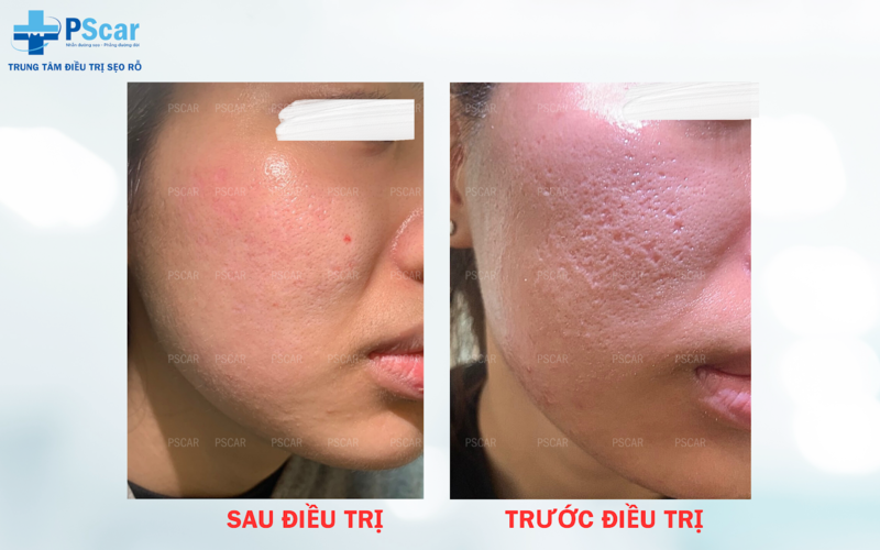 Lăn kim được xem là "cứu cánh" cho làn da sẹo rỗ với khả năng cải thiện hiệu quả lên đến 80%