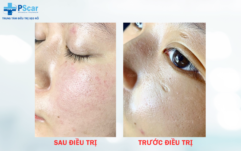 Lăn kim là một kỹ thuật thẩm mỹ giúp giảm sẹo rỗ