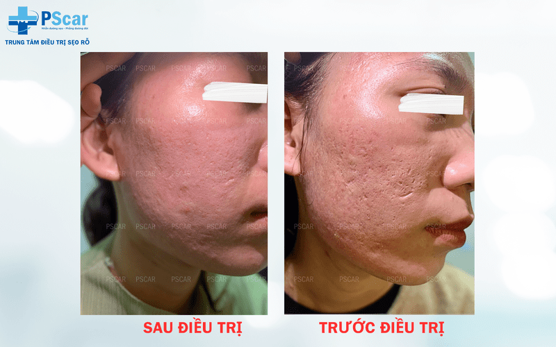 Phương pháp cắt đáy sẹo