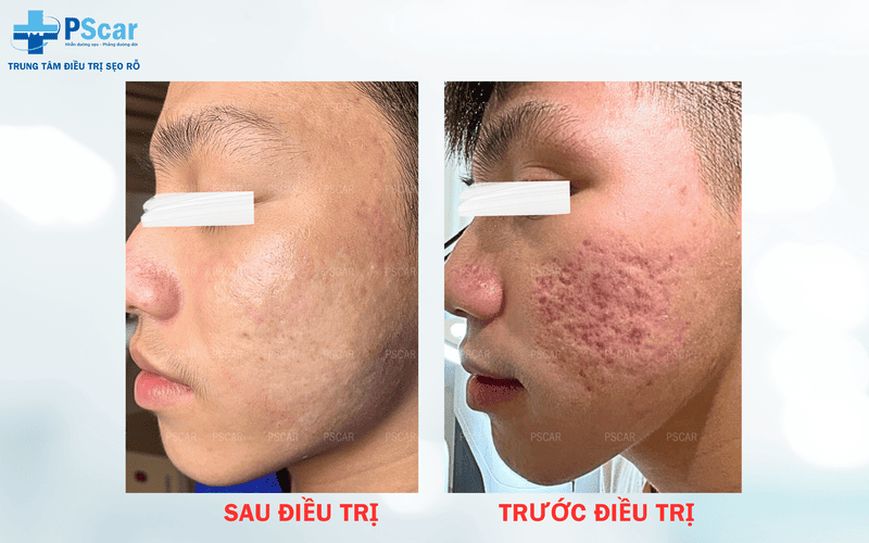 Cách trị rỗ mặt cho nam PSCAR là một địa chỉ thẩm mỹ hàng đầu