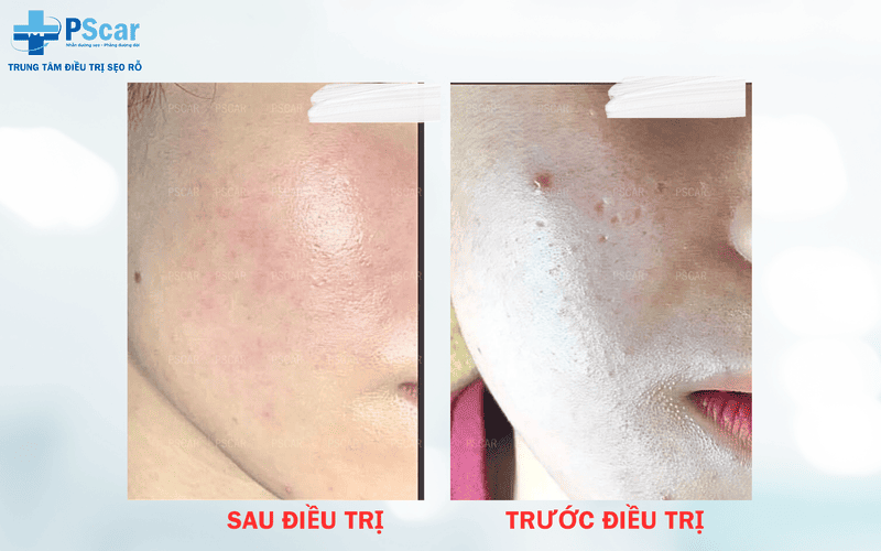 Tái tạo da bằng phương pháp cấy meso