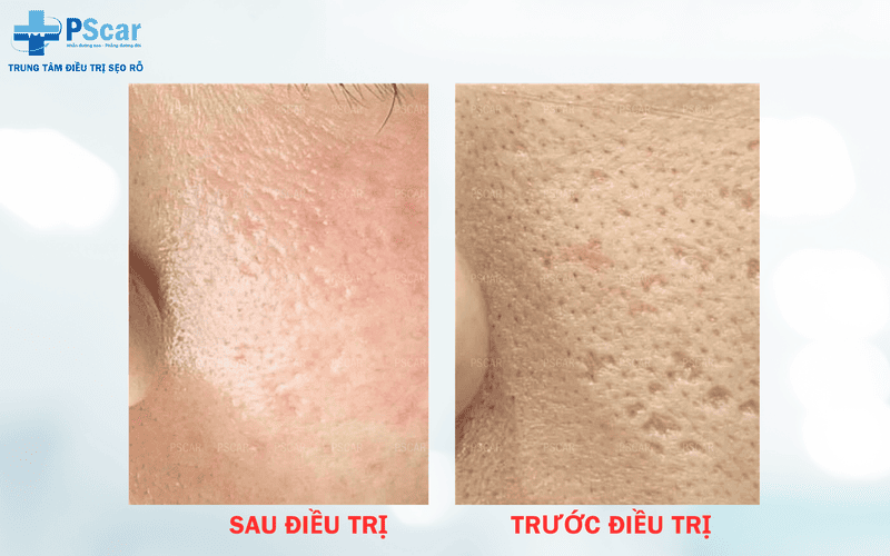 Lựa chọn phương pháp điều trị phù hợp với tình trạng da