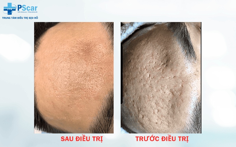 PSCAR điều trị da bị sẹo