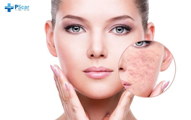 Tế bào gốc trị sẹo rỗ