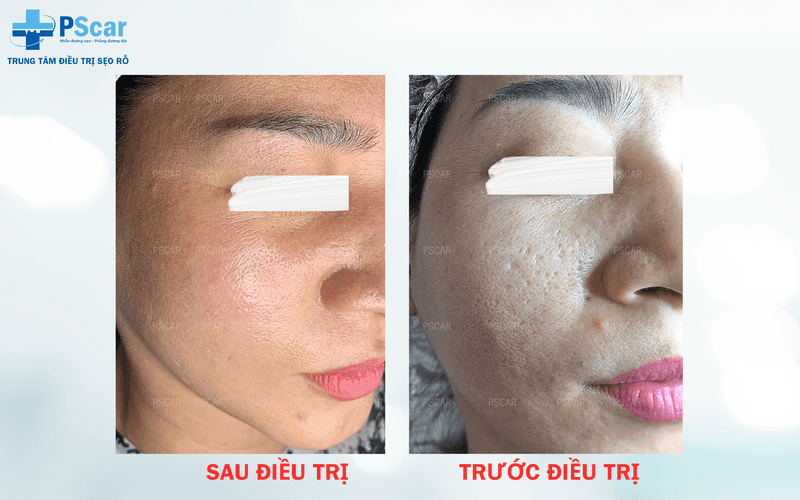Sẹo rỗ trên da mặt 