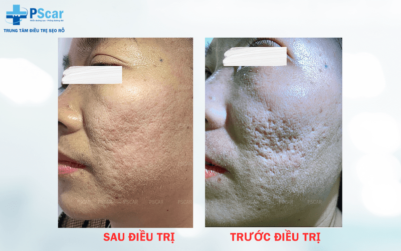 Sẹo rỗ được cải thiện 