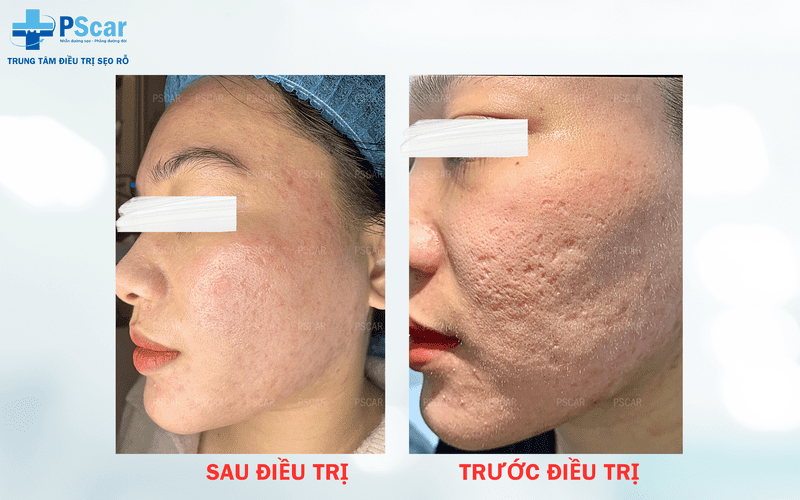 Phòng khám PSCAR chuyên điều trị sẹo rỗ